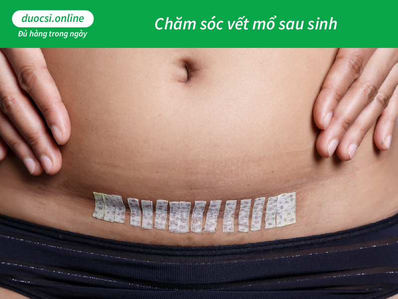 Chăm sóc vết mổ sau sinh