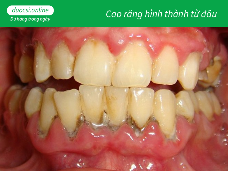 Cao răng hình thành từ đâu