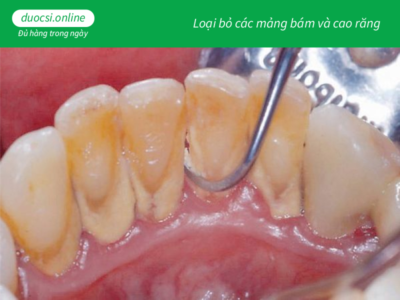 Loại bỏ các mảng bám và cao răng