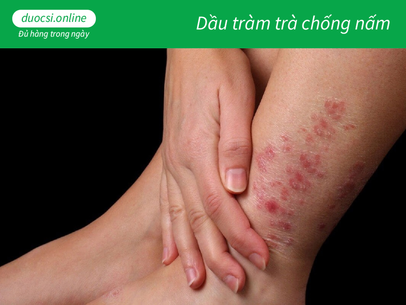 Dầu tràm trà chống nấm