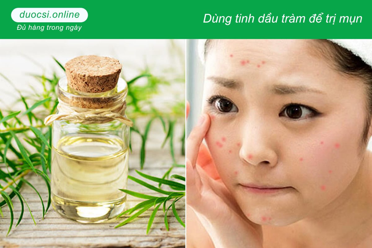 Dùng tinh dầu tràm để trị mụn